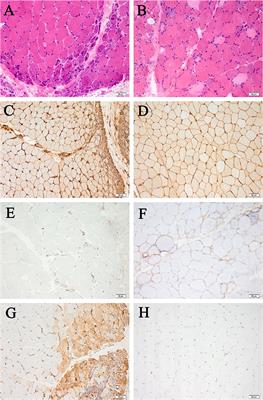 Comparison of cytokine/chemokine profiles between dermatomyositis and anti-synthetase syndrome